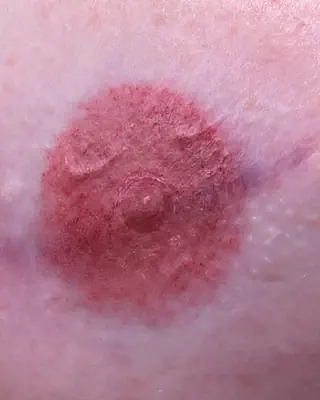 Areola tattooing after breast reconstruction: before and after photos for three clients and a close up of a tattooed areola with a shaded, 3D nipple